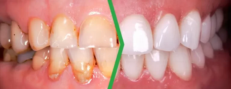 ProXental benefits